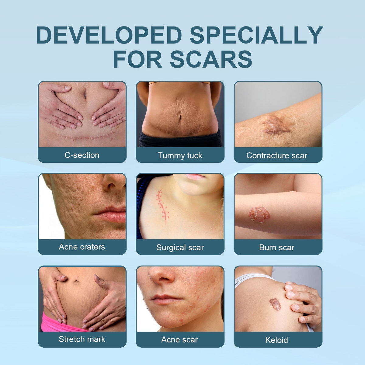 Scar Spray - Cure All Type of Scars