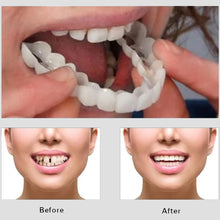 Snap On Smile - Teeth Veneers