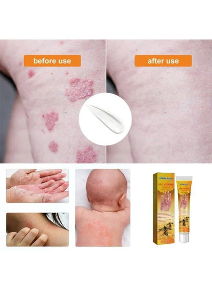 Bee Venom Psoriasis Care Cream