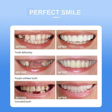 Snap On Smile - Teeth Veneers