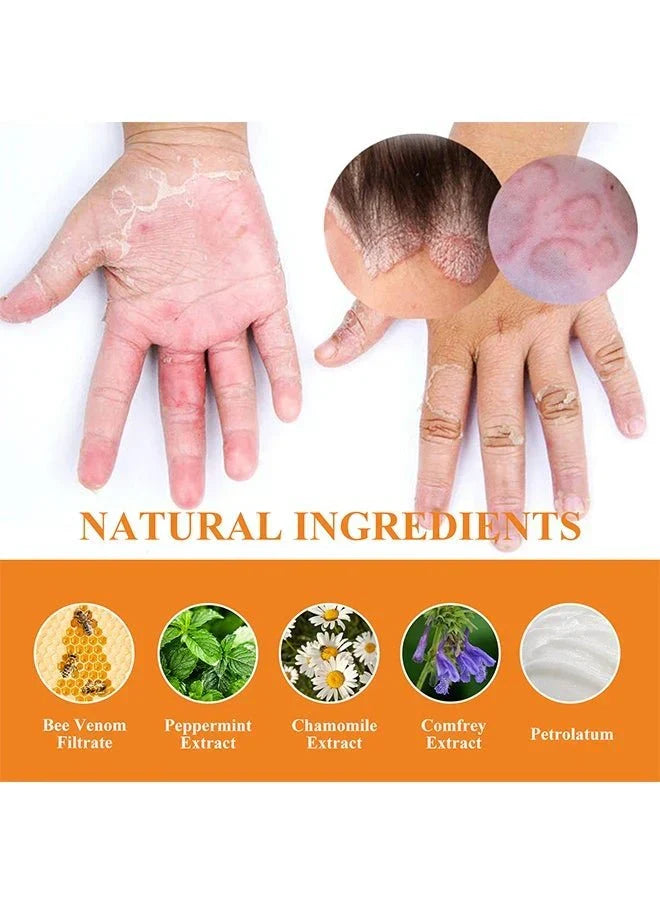 Bee Venom Psoriasis Care Cream
